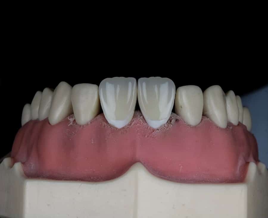 Dent Removal