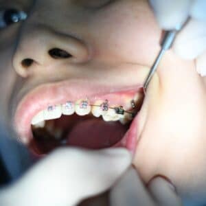 Photo Dent Removal